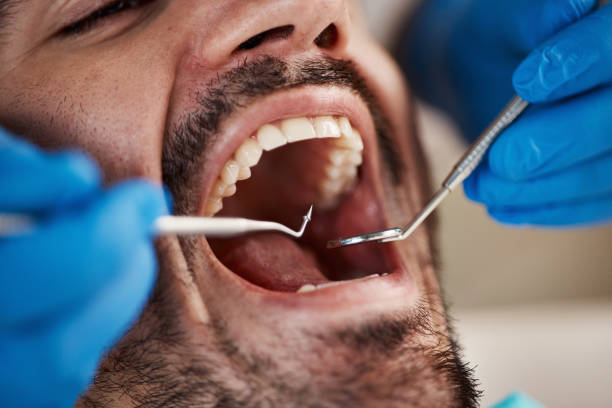 Best Emergency Dental Care for Broken or Chipped Teeth in Oxford, AL
